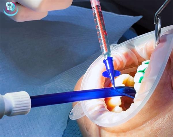 пародонтальный карман