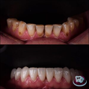До и после лечения зубов