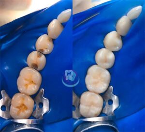 Лечение зубов