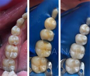 Лечение зубов в этапах