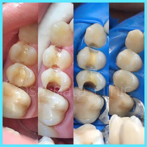 Лечение кариеса