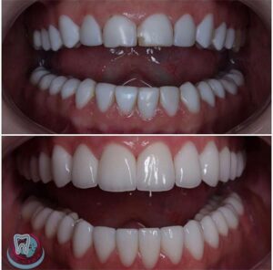 До и после исправления прикуса