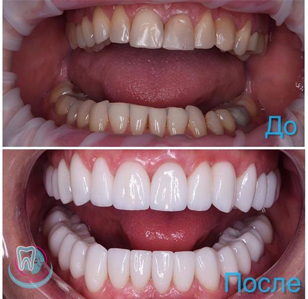 До и после чистки и отбеливания зубов
