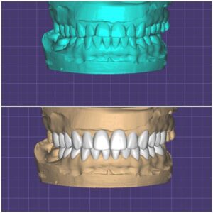 Керамическая реставрация