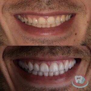 До и после чистки и отбеливания зубов