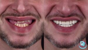 Восстановление зубного ряда до и после