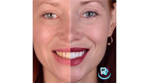 Виниры до и после