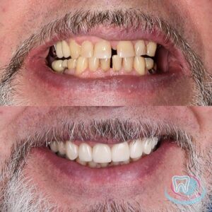 До и после зубных имплантов