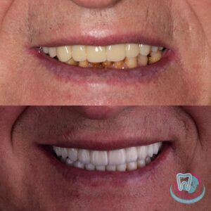 До и после отбеливания зубов