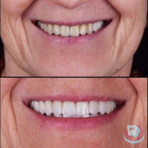 До и после отбеливания зубов