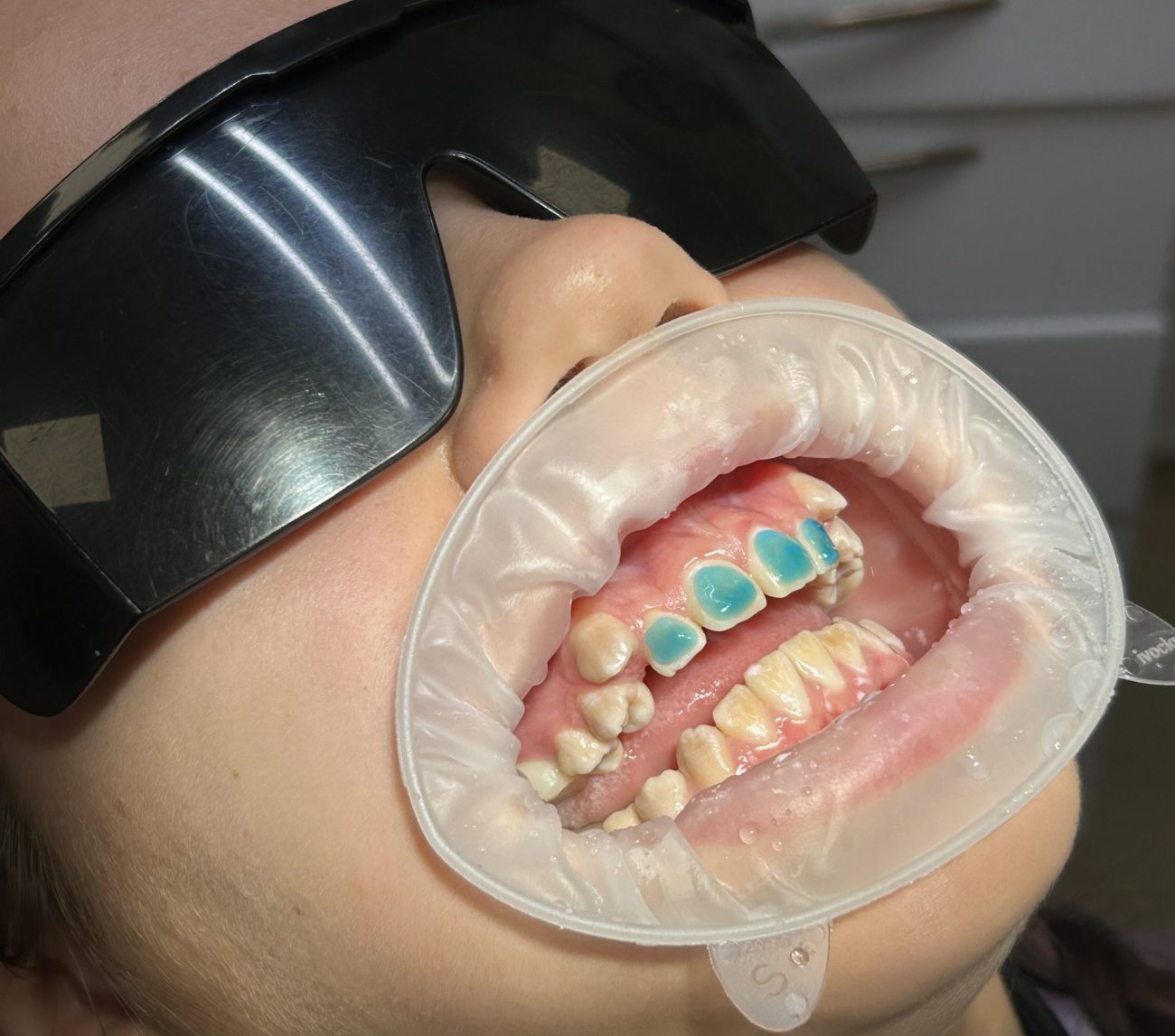 Підготовка зубів для встановлення брекетів