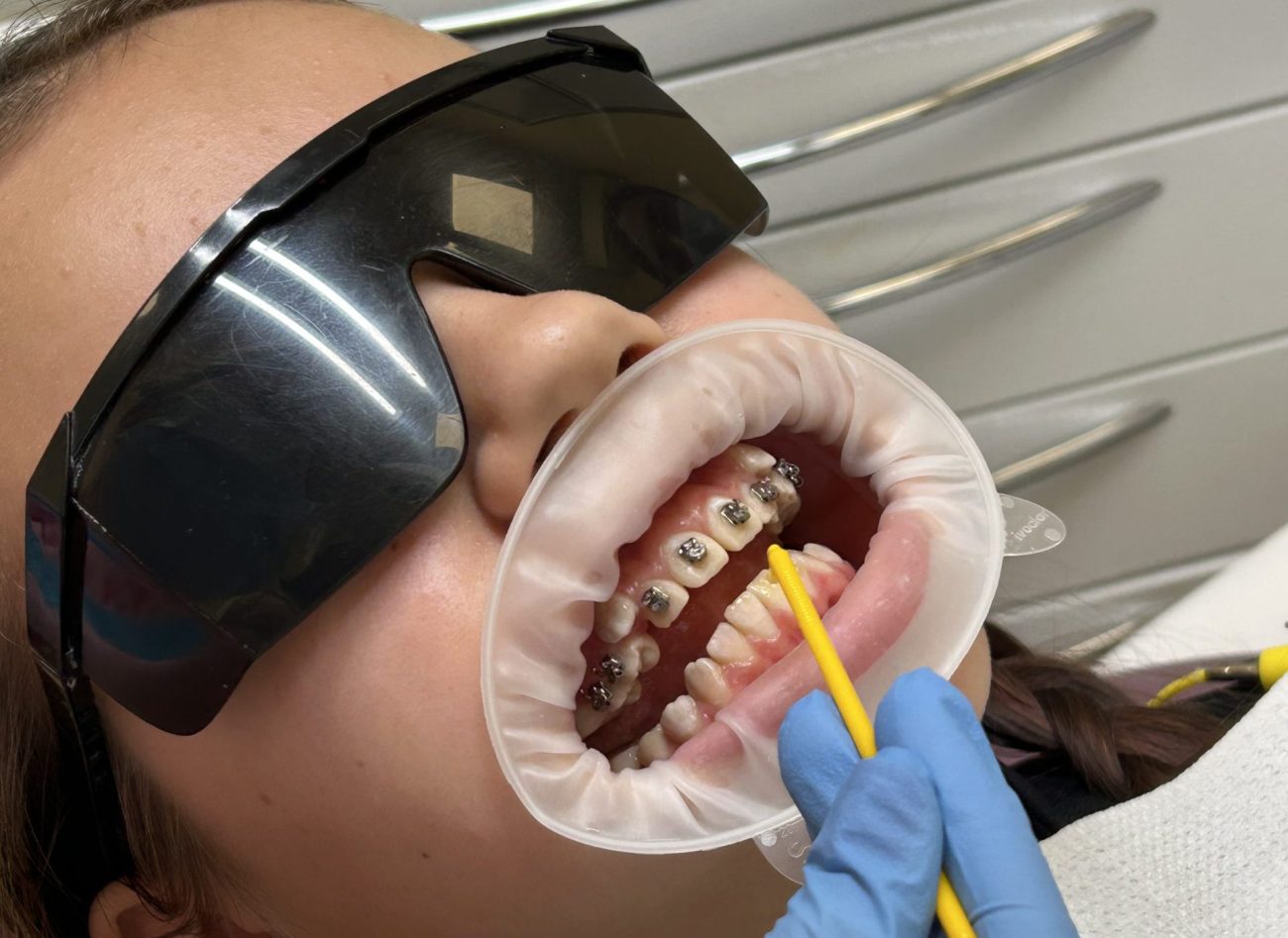 Встановлення брекетів