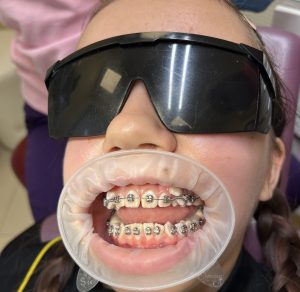 Встановлення брекетів